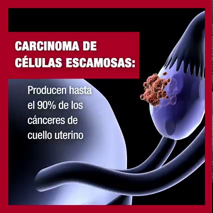 1.8K views · 62 reactions | El cáncer cervical o cáncer de cuello uterino, es una enfermedad que afecta la parte inferior del útero que conecta a la vagina. Conoce algunos de los más comunes. #Prevención #Vacunas | Hospital Auxilio Mutuo | Facebook