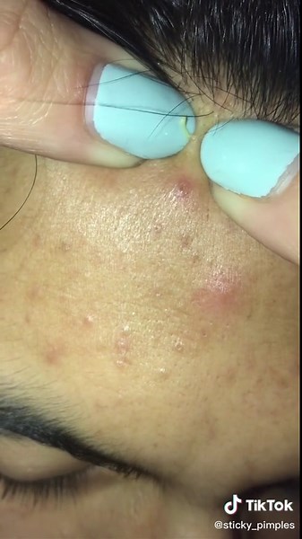 #pimplepopperaddict #pimplepoppingheaven #poppingpimple #viral #pimplepopper2021 #blackheadsremover #pimpleremoval