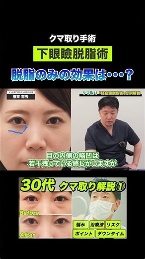 【症例解説②】下眼瞼脱脂のみの効果は？術後1週間・1ヶ月の様子