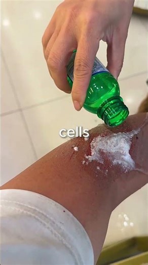 Why hydrogen peroxide is bad for wounds?🤔