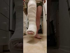 hip spica cast dhs