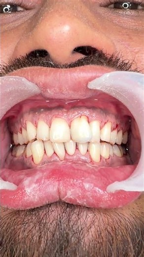 Tooth Scanning dental Scanning aero blast, air aberration touchless cleaning of teeth ￼