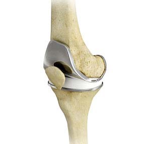 Total Knee Joint Replacement |  Mr. Janus Schaumkel Orthopaedic Surgeon Hip and Knee Joint Replacement Auckland New Zealand