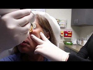 Cooltouch Varia to Remove Facial Veins with Dr. Groff