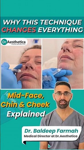 Non-Surgical Facial Rejuvenation | Cheek, Chin & Mid-Face Filler Demo