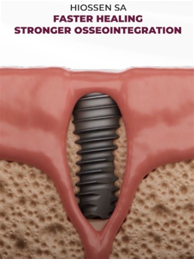 Support faster healing with a surface designed for long-term stability.🦷 Meet the ET III SA Implant by Hiossen. Featuring Hiossen’s SA surface technology, it promotes faster osseointegration and reliable implant stability for predictable clinical outcomes. ✔️SA surface technology ✔️Promotes faster osseointegration ✔️Reliable long-term stability 📲For more details, contact us: https://wa.me/201007971113 #LAMAMedical #Hiossen #ETIII_SA #DentalImplants