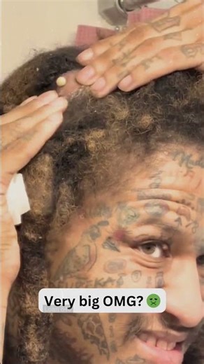 Deep Blackheads, Milia & Whitehead Removal pimple popping New| Big Cystic Acne Extraction #1222 2026