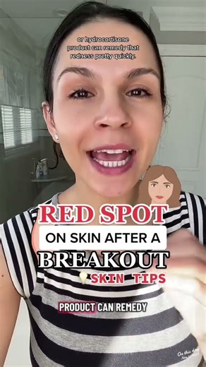 What is the red spot after a breakout on your skin? #selfcare #acne #skintips #glowupchallenge