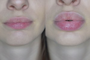 15K views · 54 reactions | Lip detox: *fuller healthier lips *treatment for chapped lips *vegan and cruelty-free | BioLips | Facebook