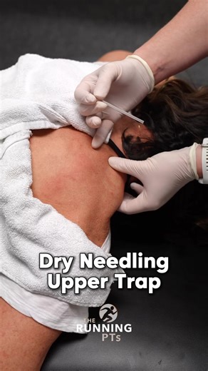 Relieve tension and pain in your upper traps with dry needling! In this quick demo, watch as we target trigger points in the upper trapezius muscle to help reduce muscle tightness, improve mobility, and promote healing. Whether you're dealing with neck pain or stress-related tightness, dry needling might be the solution you've been looking for.