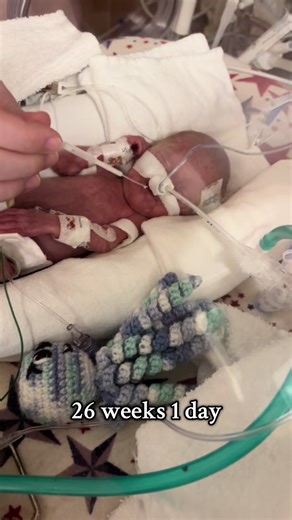 Colostrum Care for NICU Babies: A Sweet Journey