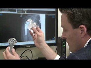 ROC Reverse Shoulder Replacement