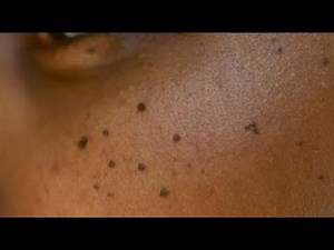 SOLUTION FOR SKIN TAGS (BLACKHEADS)