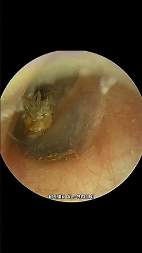 COCKROACH FOUND DEAD IN THE EAR ‼️