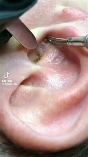 Big Pimple Videos | Follow us 👉 @cyst.removal.videos for more Videos. 👉LINK IN BIO👈 #pores #acne #skincare #blackheads #pimples #whiteheads #pimple #blackhead... | Instagram