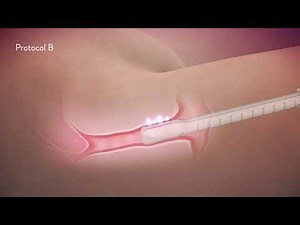 Votiva Treatment Dallas TX - ThermiVa Treatment Dallas