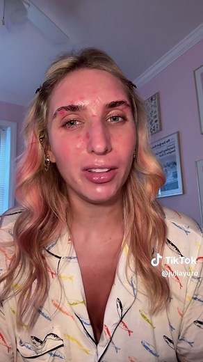 Overcoming Dermatillomania: Exposure Steps for Skin Picking