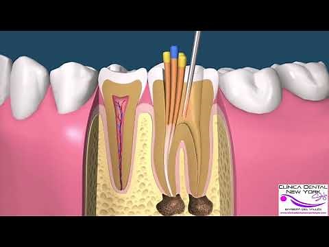 ENDODONCIA MANUAL POSTE COMPO CORONA