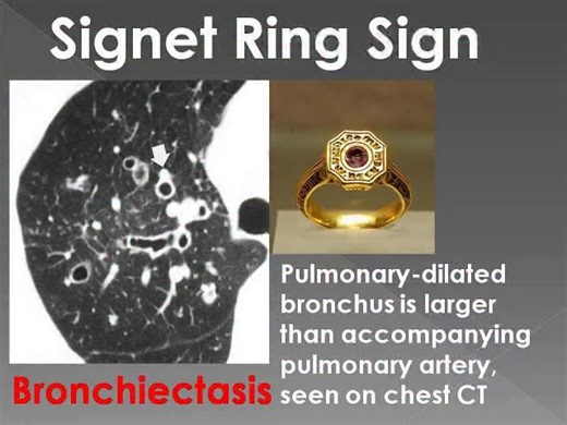 RK Medicos HUB on Instagram: "radiology, the signet ring sign is a classic imaging feature where a structure resembles a ring with a "jewel" attached. While most commonly associated with lung disease, it appears in several medical contexts. 1. Bronchiectasis (Most Common) On a High-Resolution Computed Tomography (HRCT) scan of the chest, this sign is the hallmark of bronchiectasis. The "Ring": A dilated bronchus (airway) seen in cross-section. The "Jewel": The adjacent pulmonary artery branch, w