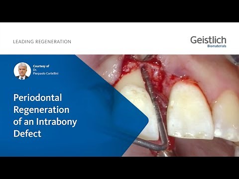Periodontal Regeneration of an Intrabony Defect - Courtesy of Dr. Pierpaolo Cortellini