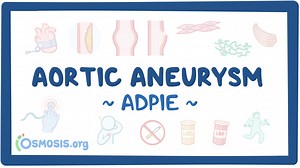 Aortic aneurysm: Nursing process (ADPIE): Video, Causes, & Meaning | Osmosis