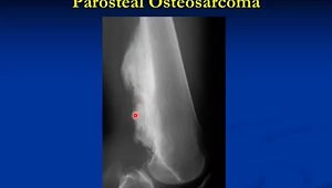 Orthopedic Oncology Course - Radiology of Musculoskeletal Tumors - Lecture 2