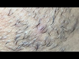 INGROWN HAIR REMOVAL #160 - Best Pluck of 2025!