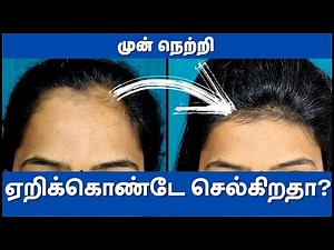 How To Treat Forehead Hair Loss : Treatment for FAST REGROW