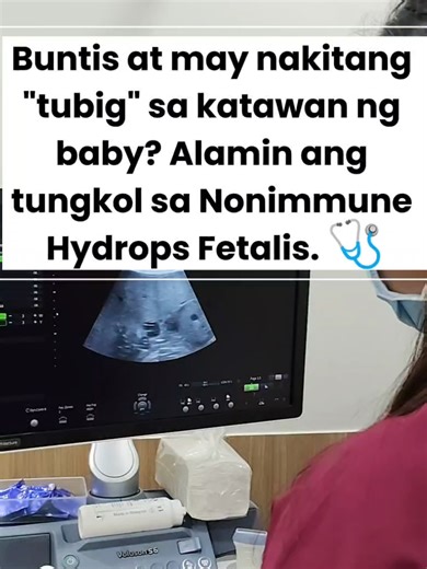 Isang 25-anyos na pasyente sa kanyang unang pagbubuntis 🤰 ang ating sinusuri ngayon dahil sa kaso ng Nonimmune Hydrops Fetalis (NIHF). 🩺✨ Ano nga ba ito? 🤔 Ang NIHF ay ang pagkakaroon ng labis na fluid o
