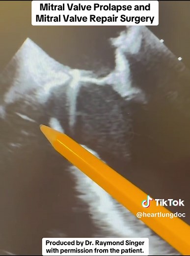 Today I’m sharing a brief video of a successful mitral valve repair for mitral valve prolapse, posted with the patient’s permission. Mitral valve prolapse is one of the most common causes of mitral regurgitation, and when addressed at the right time and in the right hands, repair—not replacement—can restore normal valve function and quality of life. A few important facts worth highlighting: Mitral valve prolapse affects ~2–3% of the population. In experienced centers, >90–95% of degenerative mit