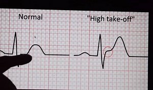 How to read ECG? Great Explaination. | Medcity International Academy