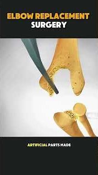 Artificial Elbow Implant Procedure (3D) #3dmedicalanimation #aigenerated #elbowpain #elbowjointpain