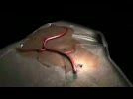 Animation of metastasis - ecancer