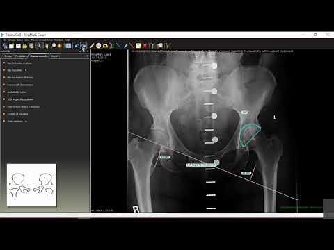 Getting started with TraumaCad Webinar