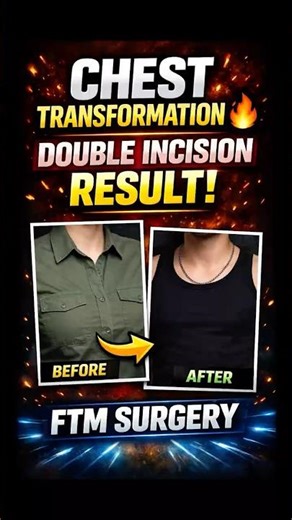 FTM Chest Dysphoria GONE | Double Incision Mastectomy Before After #topsurgery #ftm #transformation