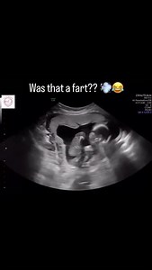5.6K views · 3.6K reactions | Do babies ACTUALLY fart inside the...