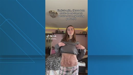 What is ‘Toasted Skin Syndrome?’ | Experts explain the viral condition