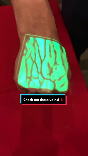 Portable Vein Finder Device for Efficient IV Insertions