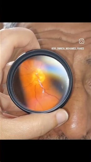 Myelinated Retinal Nerve Fiber (MRNF)layer #eyes #retina #ophthalmology #eyedoctor #ophthalmologists