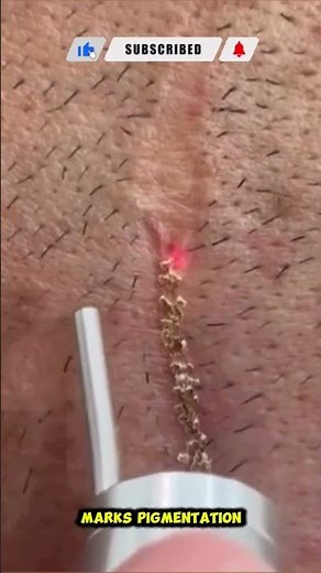 Fractional CO2 Laser: The Most Powerful Treatment for Surgical Scars & Skin Renewal #co2laser