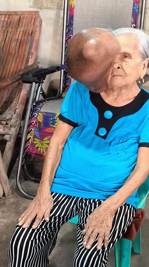 Sa kabila ng malaking bukol sa mukha hindi parin nawawala ang ngiti ni nanay. 🥹💖 Kahit may sakit at hirap positibo pa rin ang pananaw niya sa buhay. Tunay na inspirasyon, lakas ng loob at puso ng isang ina. 🙏 | Julie Gannaban