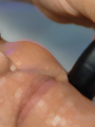 Why RF Therapy remains the #1 technology for skin aging and lifting: When it comes to advanced anti-aging treatments, radiofrequency is not just a trend — it’s science-backed skin transformation. RF energy gently heats the dermal layers, stimulating fibroblasts — the cells responsible for collagen and elastin production. This controlled thermal effect triggers the skin’s natural repair process, resulting in: • Improved firmness and elasticity • Reduced fine lines and wrinkles • A visibly smoothe