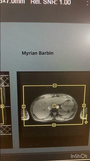MRI Abdomen Exam #diagnosticradiology #radiology #science #mri #mrimachine #mritech