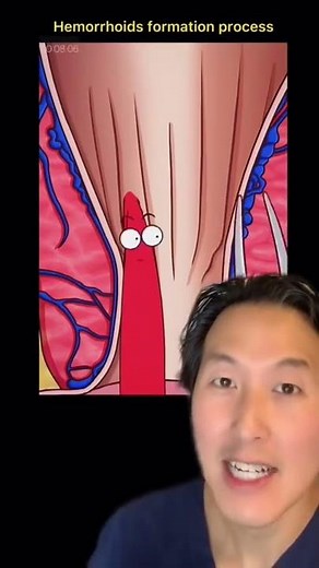 What is a Hemorrhoid and How Do You Treat It? #shorts #hemorrhoids