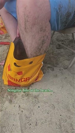 “Ouch! Stingray Sting in Long Beach 😱🔥 #BeachFail”