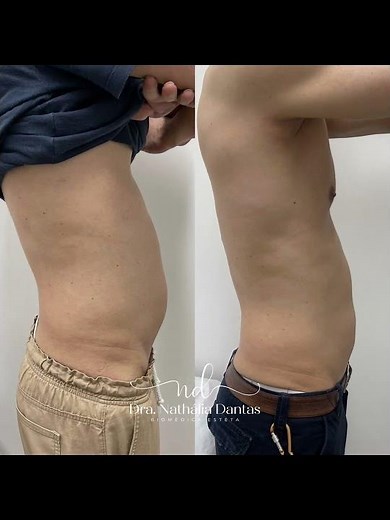 Antes e depois da aplicação de enzima para gordura localizada #gorduralocalizada #enzimas