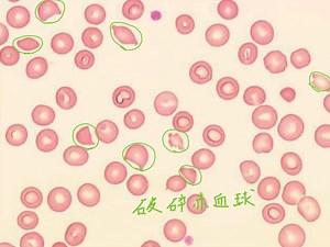 血栓性血小板減少性紫斑病（TTP）の骨髄所見で巨核球は増加するのか？ 〜検査の必要性〜 | コウメイ塾