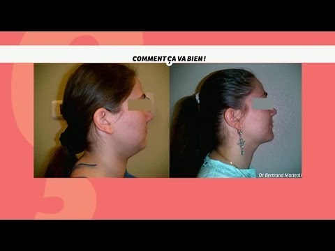 [HEALTH] Double Chin Surgery #CCVB