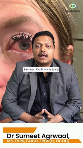 Aankh ki Safed Jagh Sooj Gayi? Ye Eye Chemosis Ho Sakta Hai 👁️