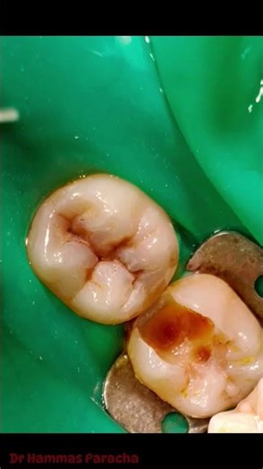 Stronger Than Before 💎 | Posterior Composite Restoration Case